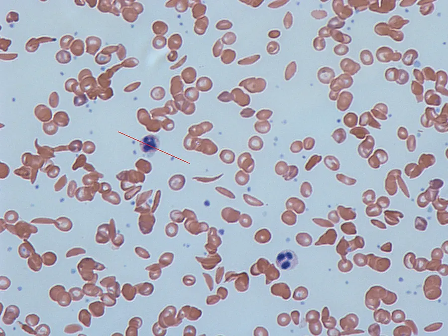 A blood smear under the microscope, in which some red cells have the crescent shape that gives sickle cell disease its name