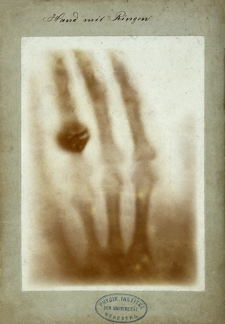 Röntgen's X-ray of his wife Anna Bertha's hand, with her ring, made on 22 December 1895.